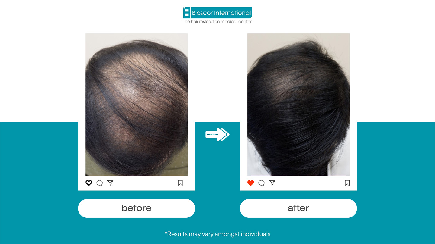 ผู้ชายศีรษะล้านบริเวณกลางกระหม่อม มีปัญหาผมบางจากพันธุกรรม